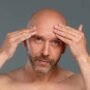 Best-Scalp-Hair-Removal--Electrolysis-or-Laser