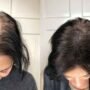 How Scalp Micropigmentation Can Transform Your Hairline