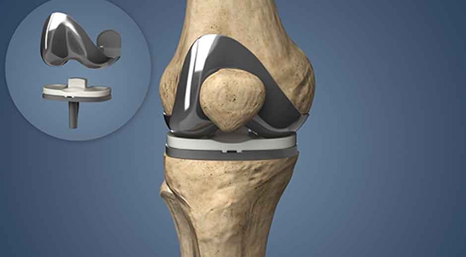 How-Knee-Arthritis-Leads-to-Knee-Replacement-Surgery