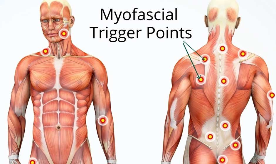 Understanding Your Body's Trigger Points and Their Effect on Movement